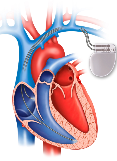 The image illustrates the Permanent Pacemaker Insertion procedure.