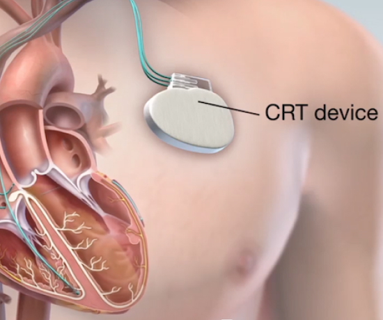 The image shows the placement of a CRT device in the heart.